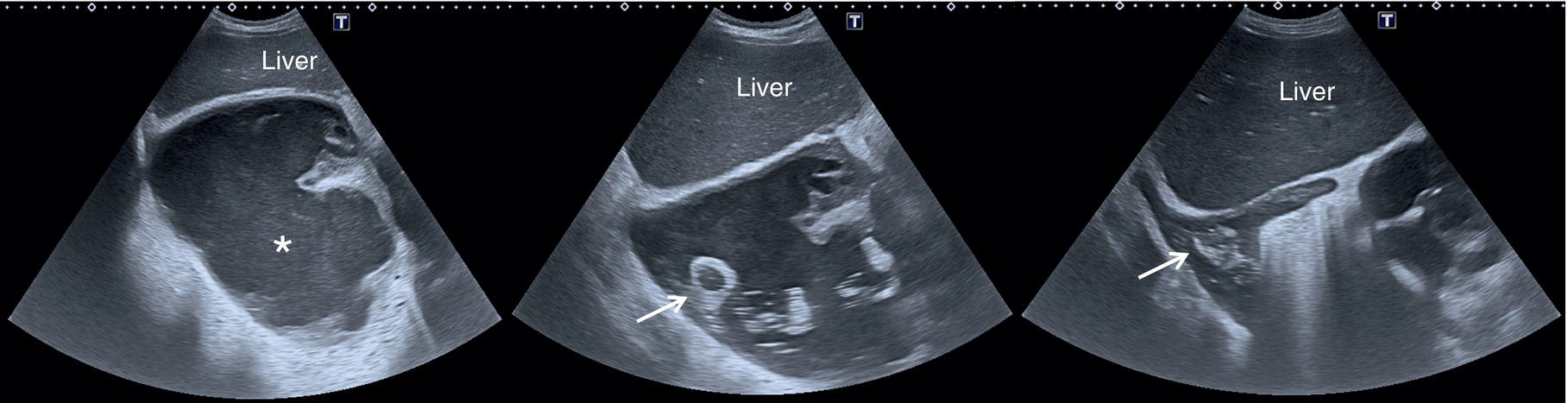 A set of three ultrasounds. A. A large echogenic right pleural effusion denoted by asterisk. B. It displays a reduction of effucion. C. It displays a decompression of right liver lobe.