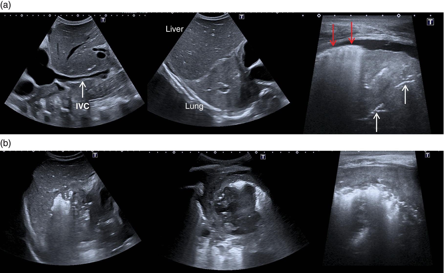 A set of six ultrasounds of a patient affected by respiratory failure and sepsis. A. A severe hypovolemia, I V C collapse at inspiration. The arrows denote the air branchogram. It also displays lung abscess.