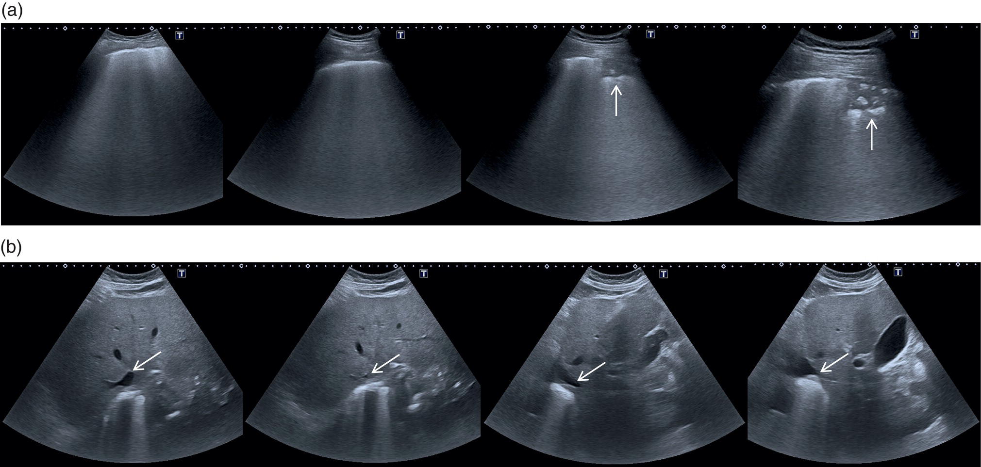 A set of two ultrasounds. A. The arrow marks denote bilateral and subpleural lung consolidation. B. The arrow here denotes the inferior vena cava with collapse at inspiration. Display of severe hypovolemia.