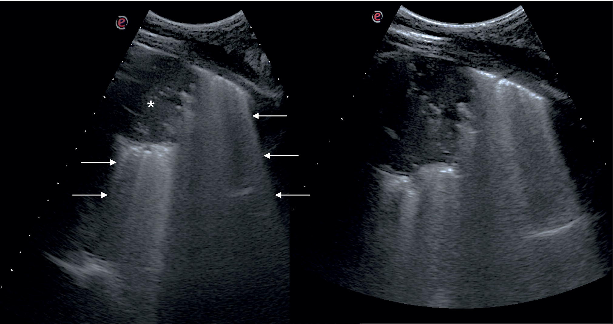 A set of two ultrasounds of a patient with severe fungal pneumonia. The asterisk denotes the subpleural round in the parenchymal consolidation. The arrows denote the interstitial lung involvement.