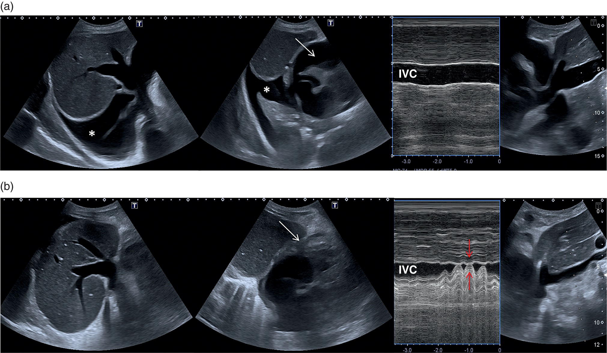 Two sets of scan images. It depicts the large right pleural effusion, pericardial effusion, inferior vena cava, respiratory variations, I V C respiration, and periodic space is depicted and their measurements are depicted.