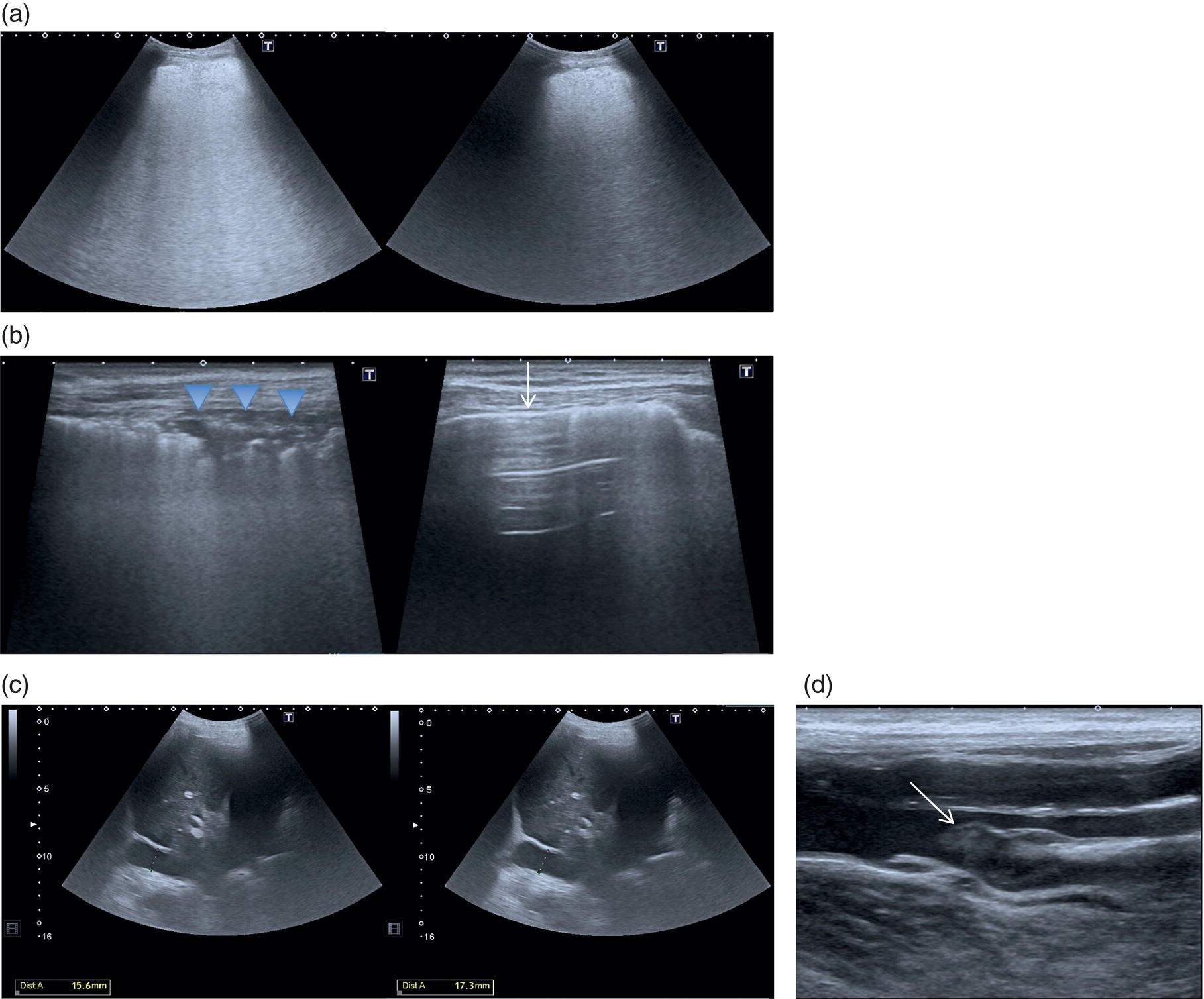 Four sets of scan images depict severe respiratory failure and sepsis. The bilateral thick, linear transducer, inferior vena cava, central venous pressure, lower limbs of the femoral veins, and the thrombus at the bifurcation and its measurements are displayed.