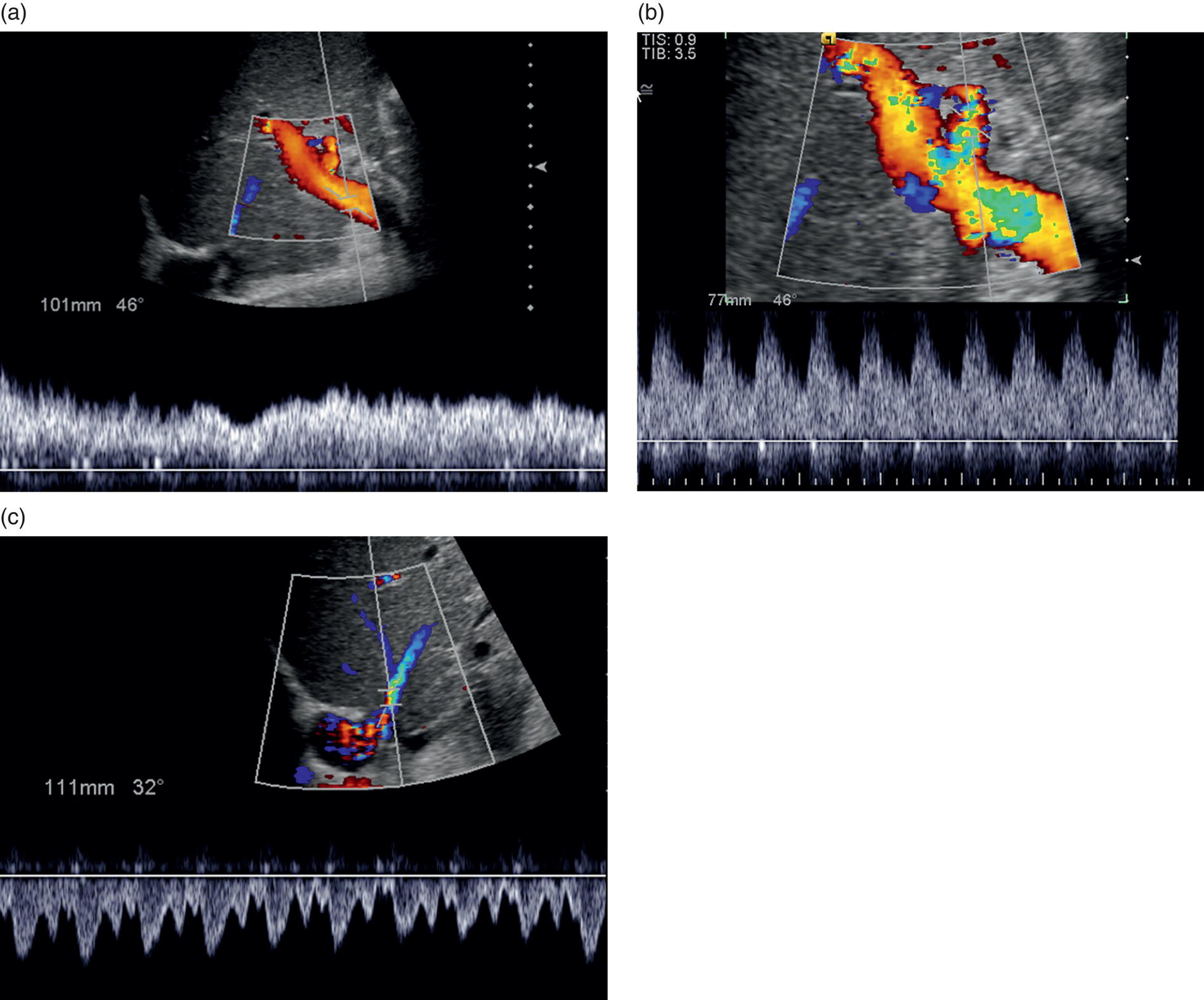 Three radiograph images. a. The doppler examination of the portal vein measured 101 millimeters. b. The heppatic artery measures 77 millimeters. c. The hepatic vein measures 111 millimeters.