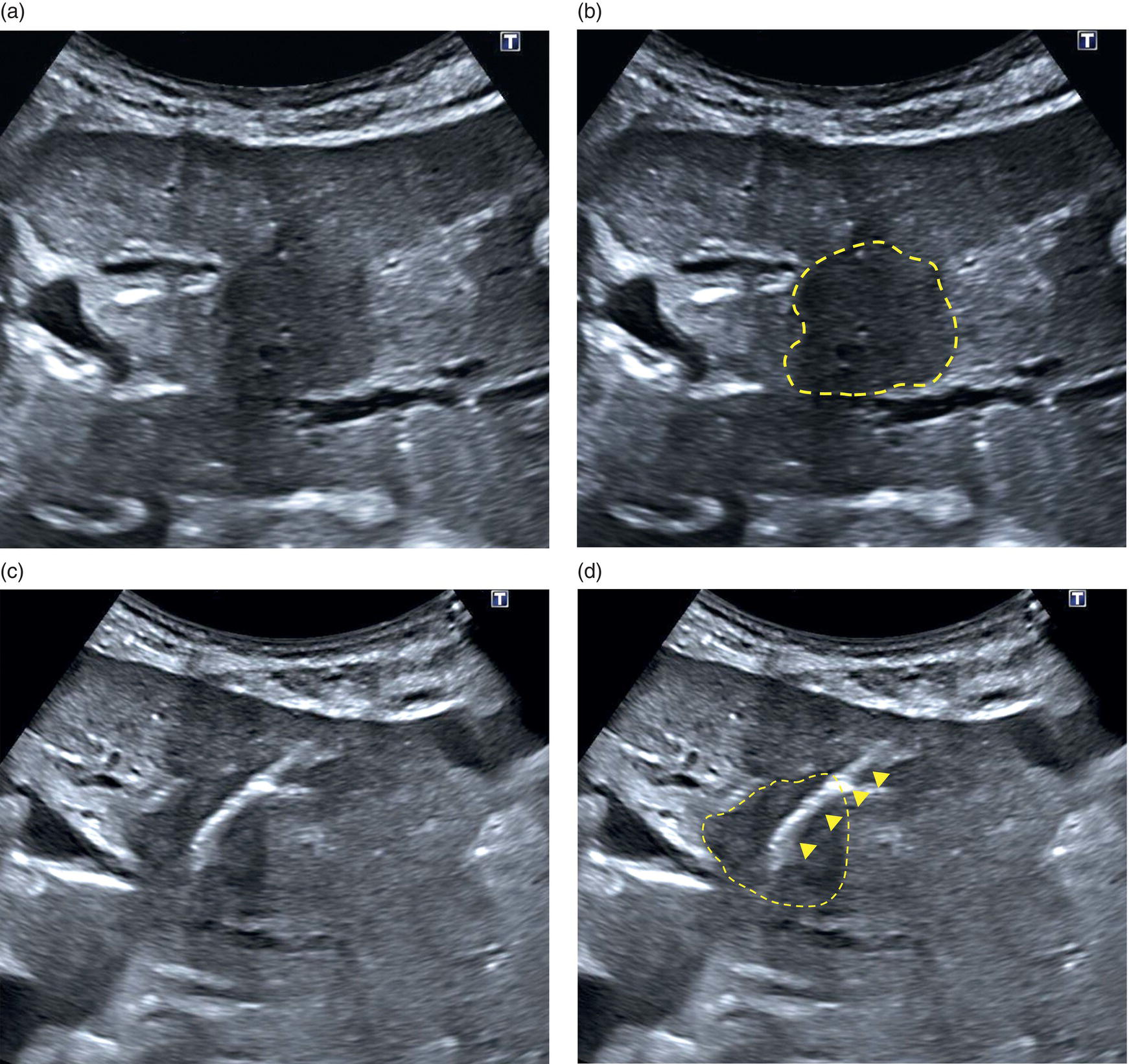 Four ultrasound scan images depict a hypoechoic lesion in segment 2 of the liver and the left lobe of the liver with a biopsy needle in the target lesion is highlighted.