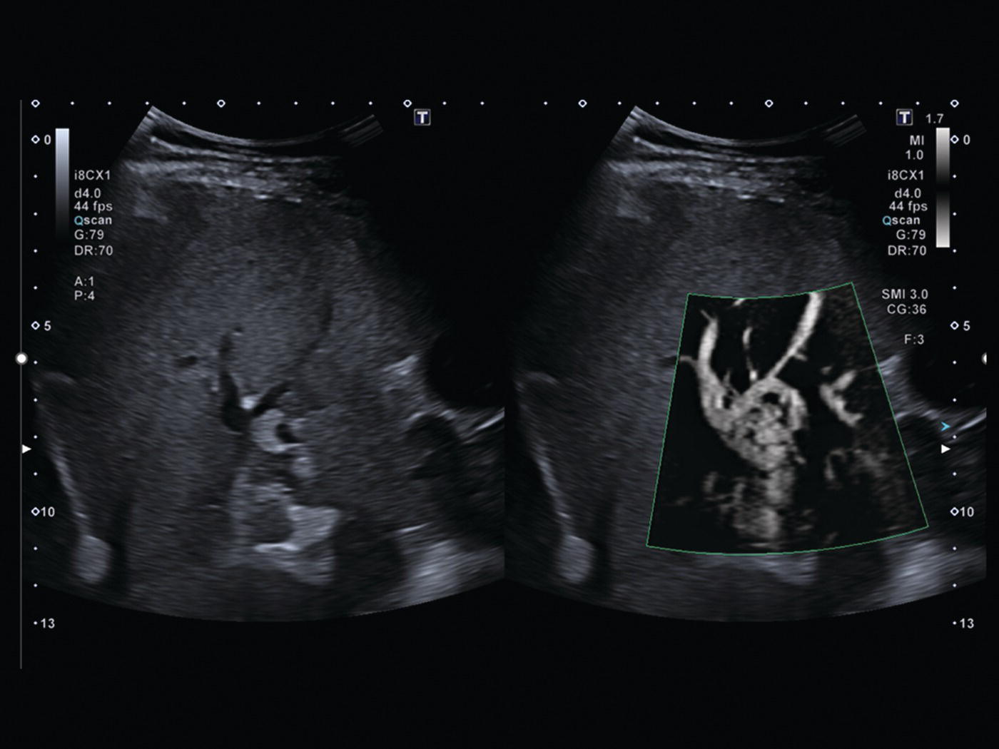 A radiograph depicts the thrombosed portal vein with collaterals. The superb microvascular imaging, flow imaging of the vessels, and its measurements are depicted.