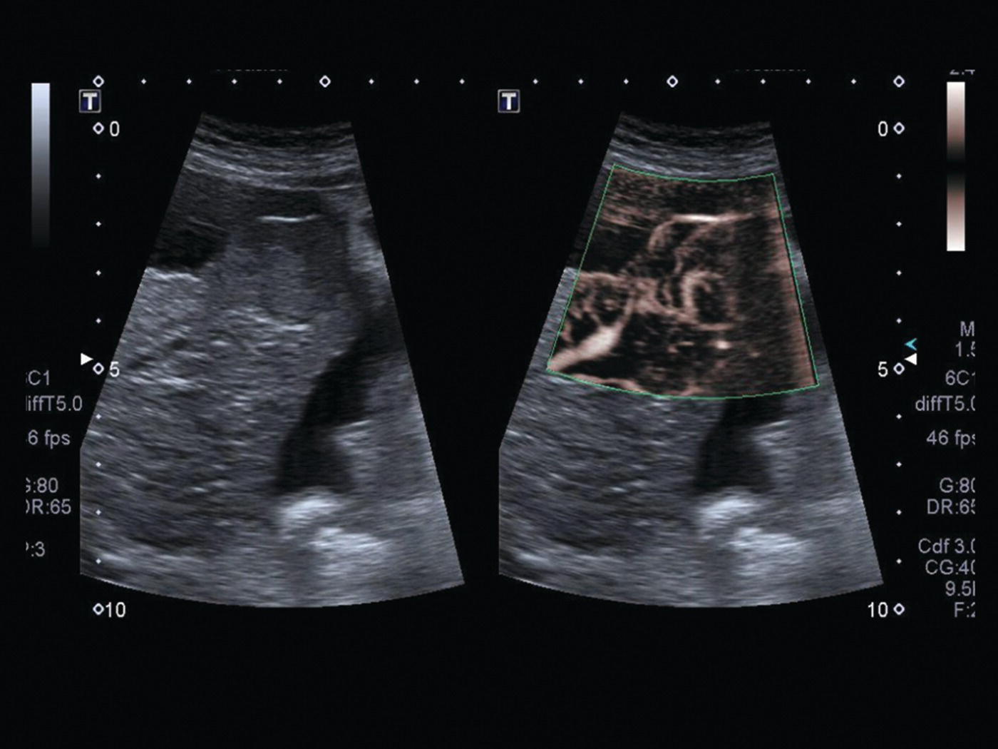 A radiograph image depicts the focal lesion on a background of liver cirrhosis. The nodular edge and ascites are in segment 6 of this liver. The superb microvascular imaging is also depicted.