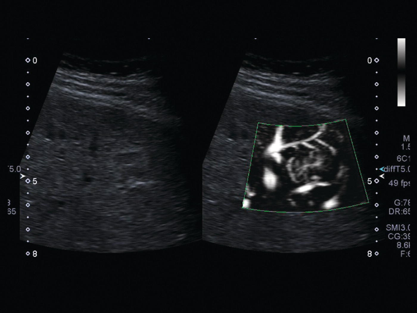 A radiograph depicts the subtle hypoechoic lesion in the liver and the superb microvascular imaging. The spoke-wheel pattern of this lesion is depicted.