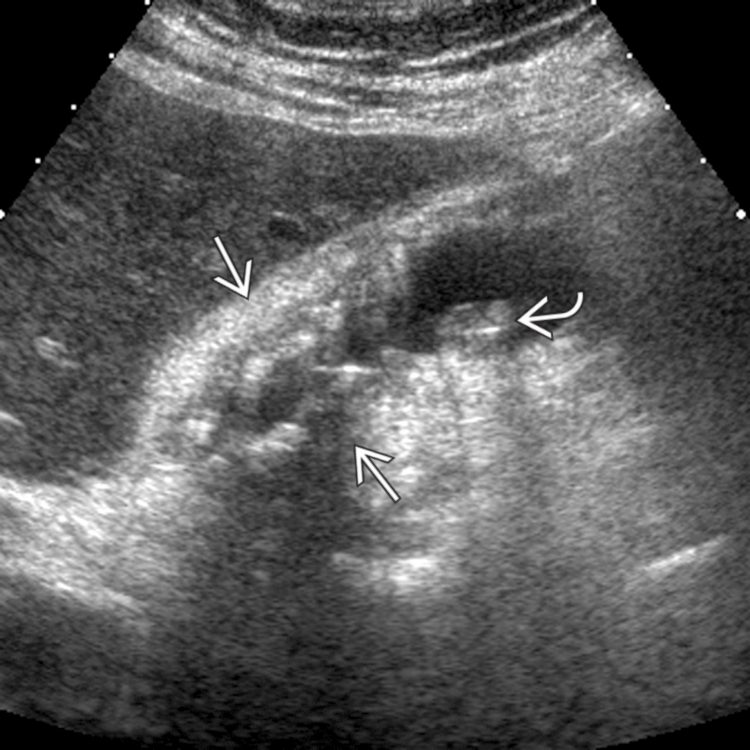 Gallbladder Adenomyomatosis Radiology Key