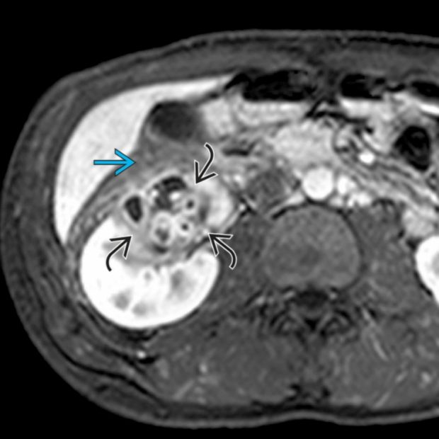 Hydrosalpinx | Radiology Key