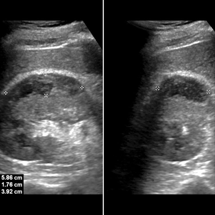 Pyonephrosis | Radiology Key