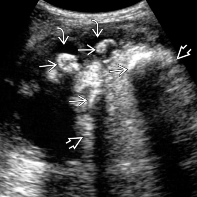 Xgp Radiology Xanthogranulomatous Pyelonephritis | Radiology Key