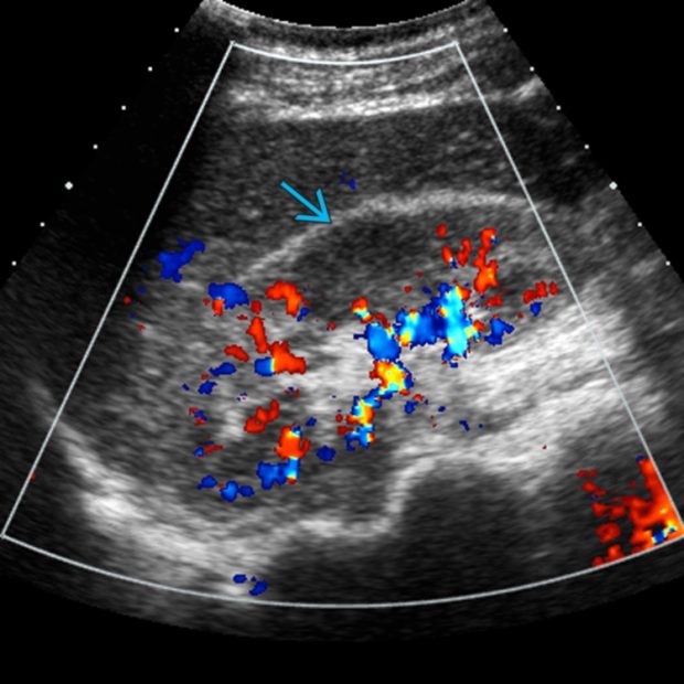 Hematoma/Seroma | Radiology Key