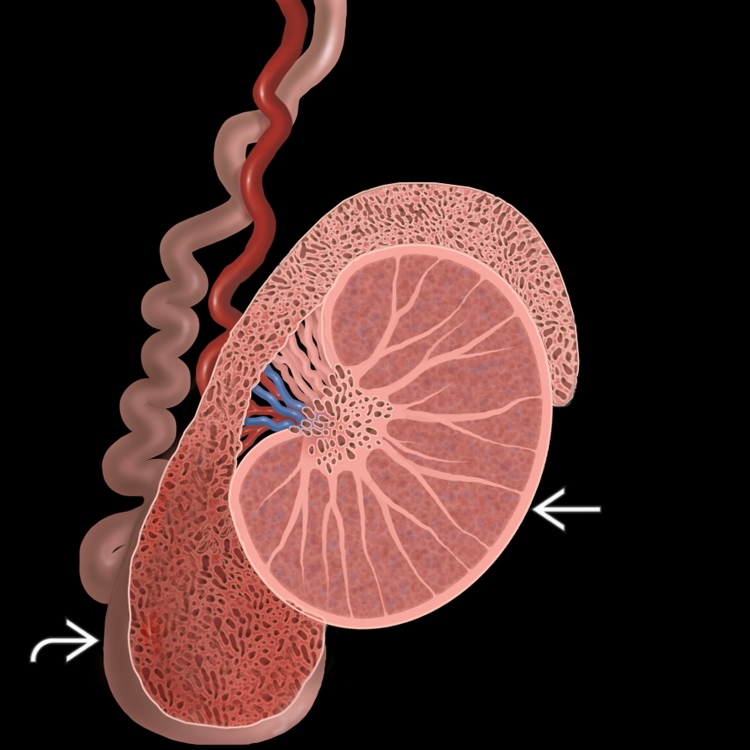 Epididymitis Orchitis Radiology Key