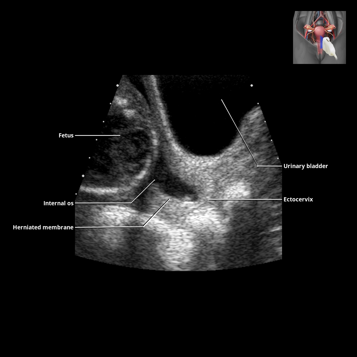 cervix-radiology-key