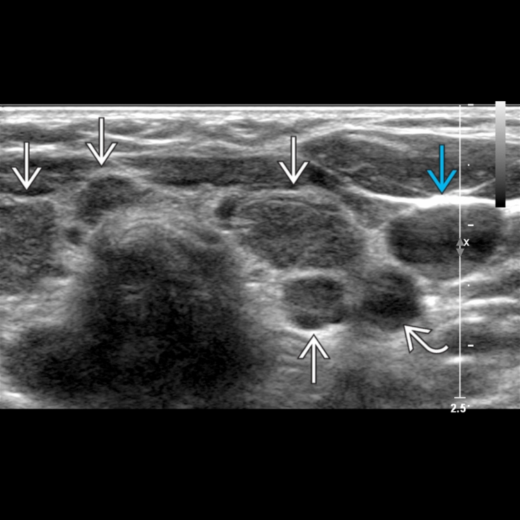 Hashimoto Radiology Hashimoto Thyroiditis | Radiology Key