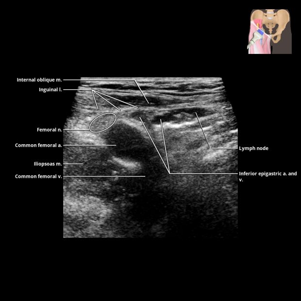 Perinephric Hematoma | Radiology Key