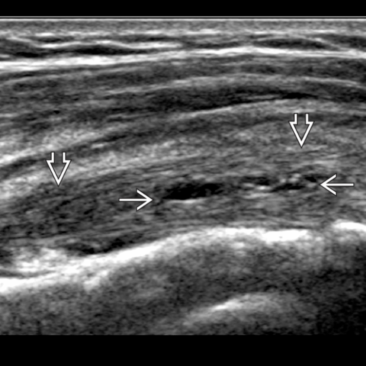 Rotator Cuffbiceps Tendon Tear Radiology Key