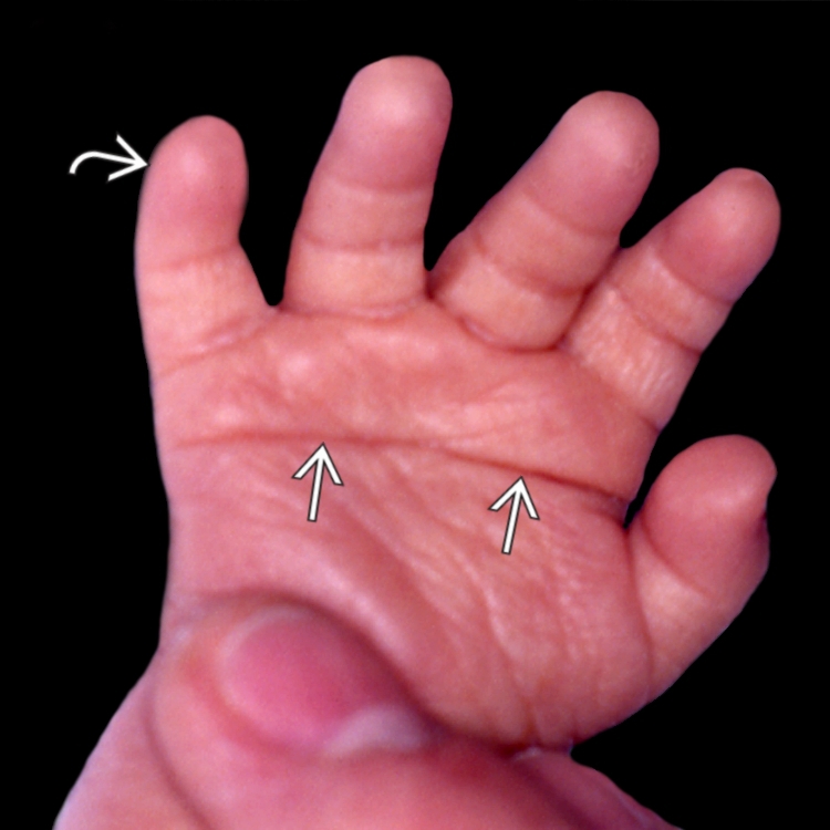 Abnormal Hand | Radiology Key