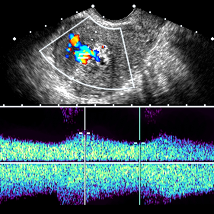 Retained Products of Conception | Radiology Key