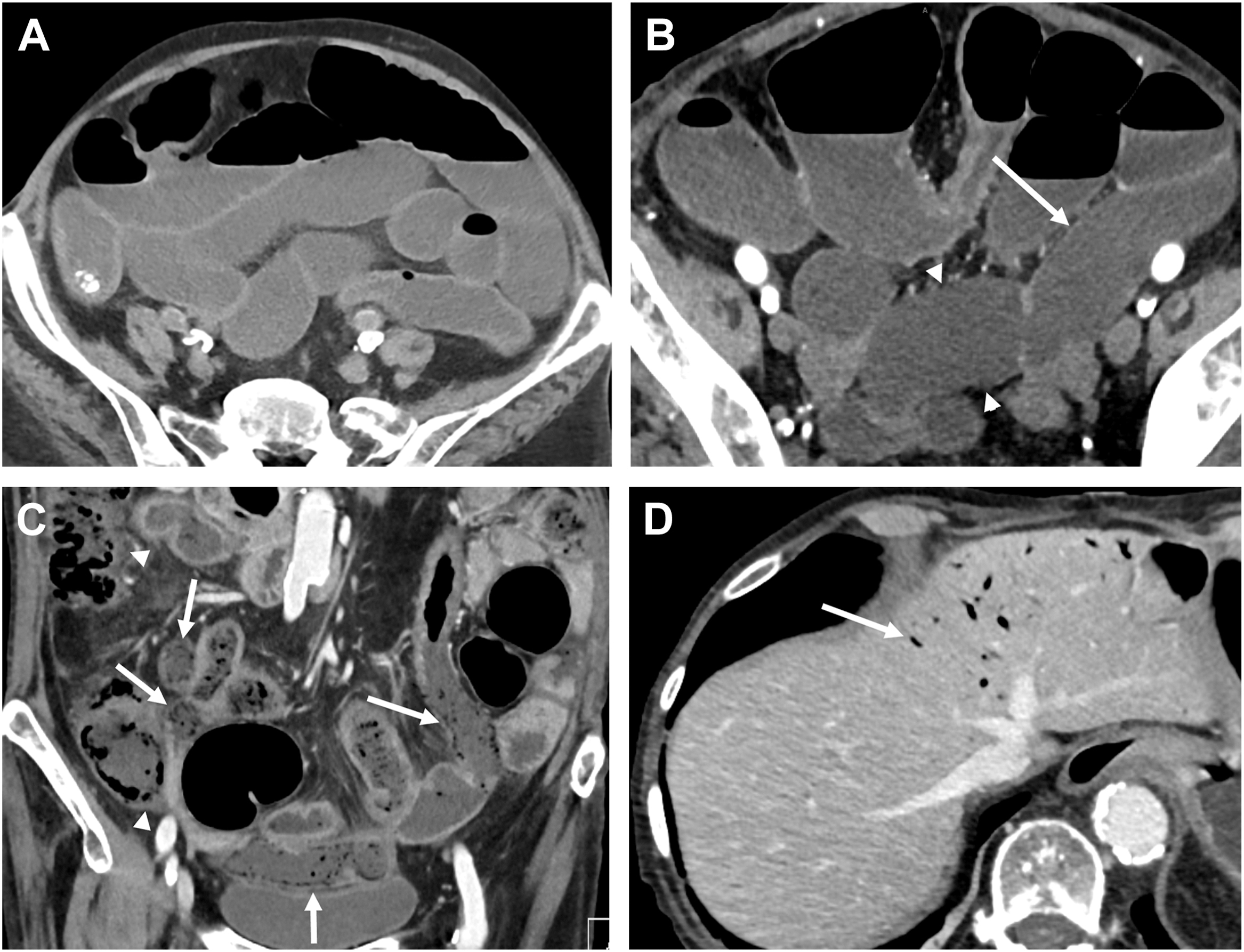 Computed Tomography Imaging for Suspected Gastrointestinal Bleeding and ...