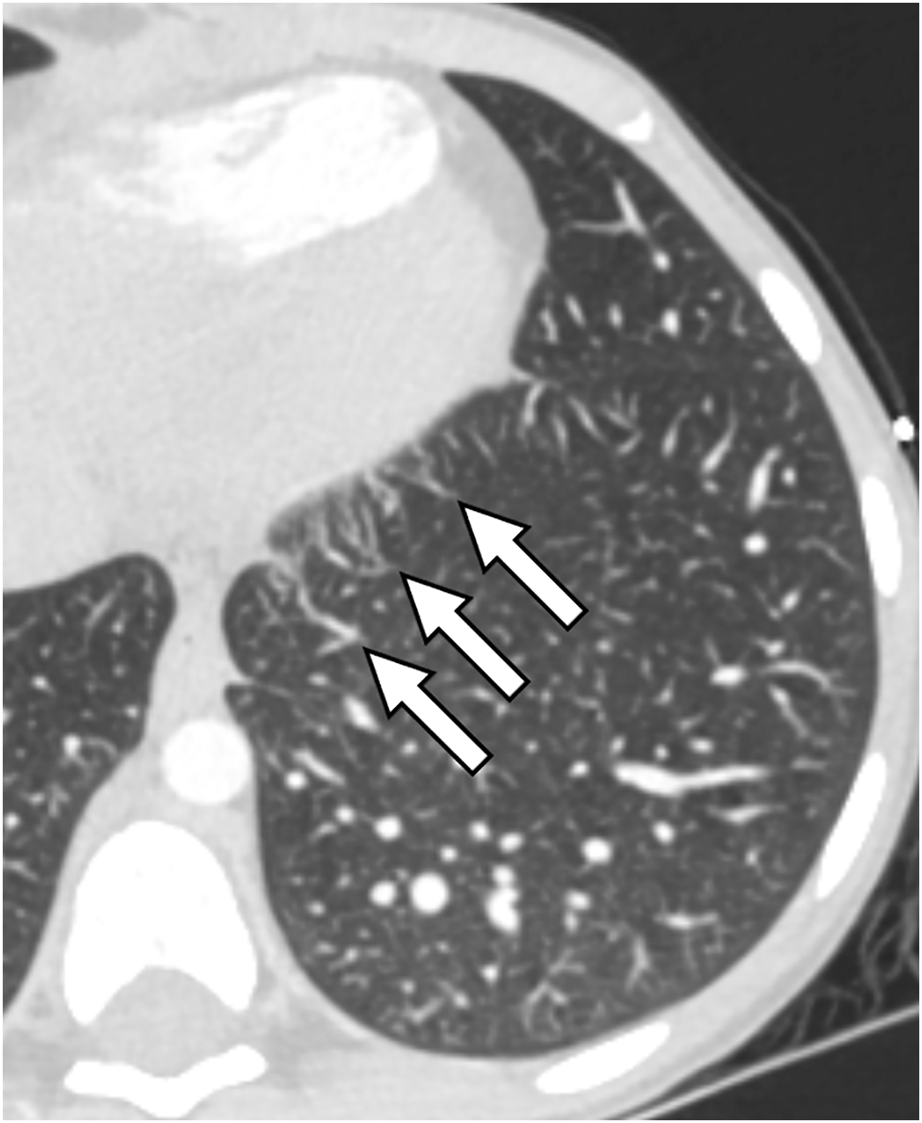 Neonatal and Pediatric Pulmonary Vascular Disease | Radiology Key