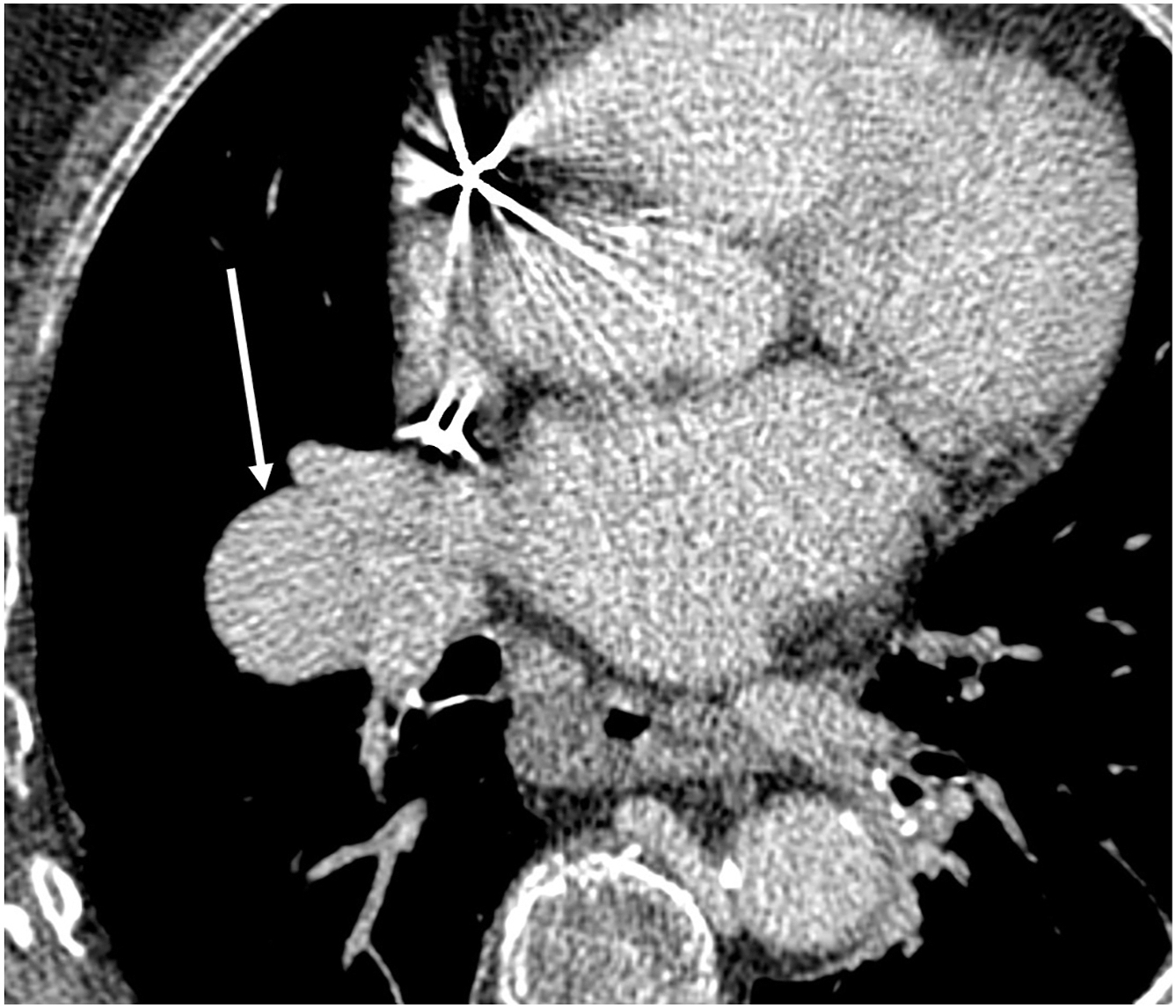 Congenital Pulmonary Vascular Anomalies and Disease | Radiology Key