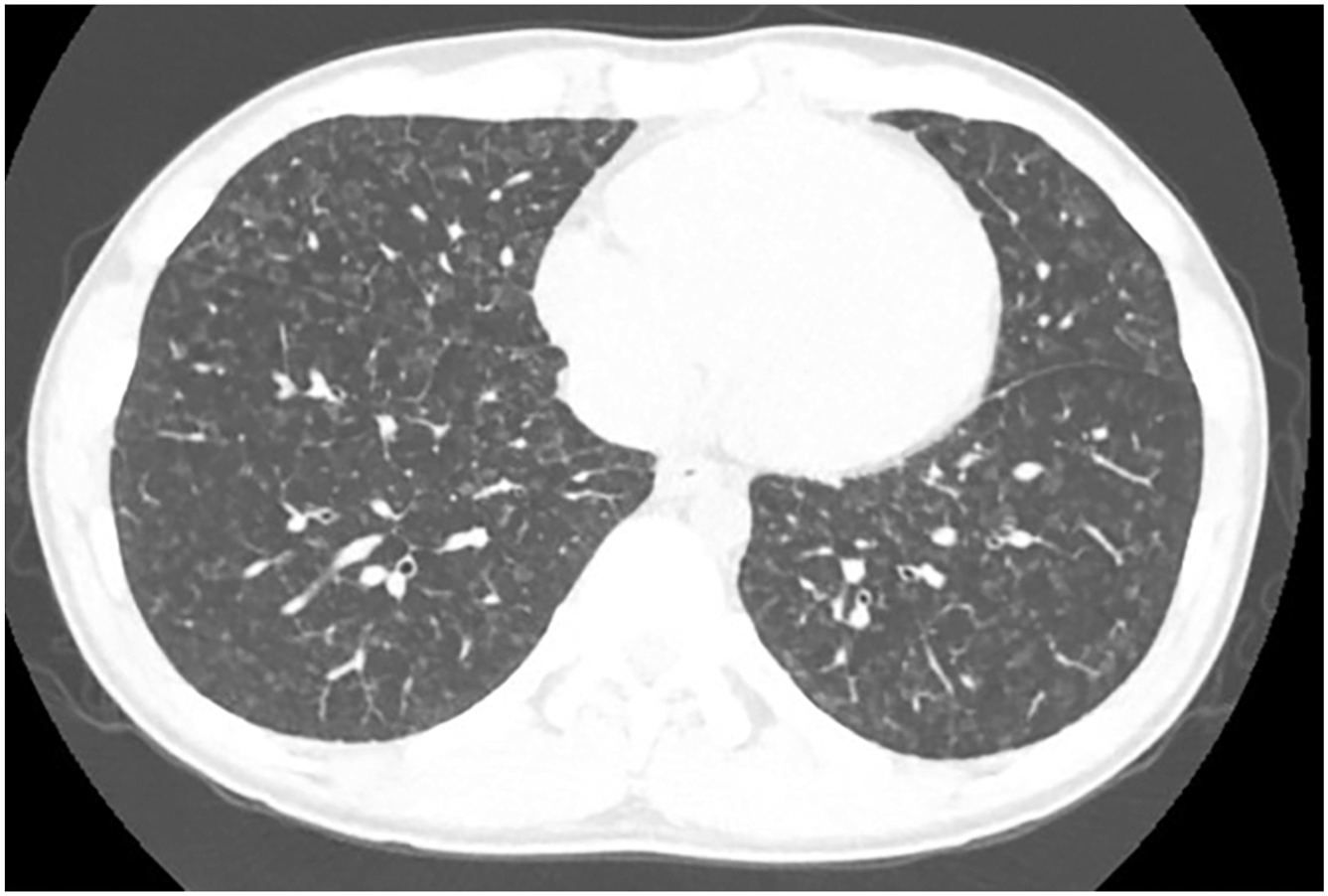 The Role of Imaging in Pulmonary Vascular Disease | Radiology Key