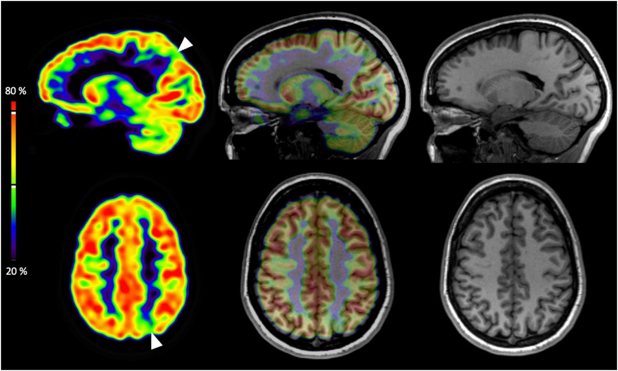 Brain PET Imaging in the Presurgical Evaluation of Drug-Resistant Focal ...