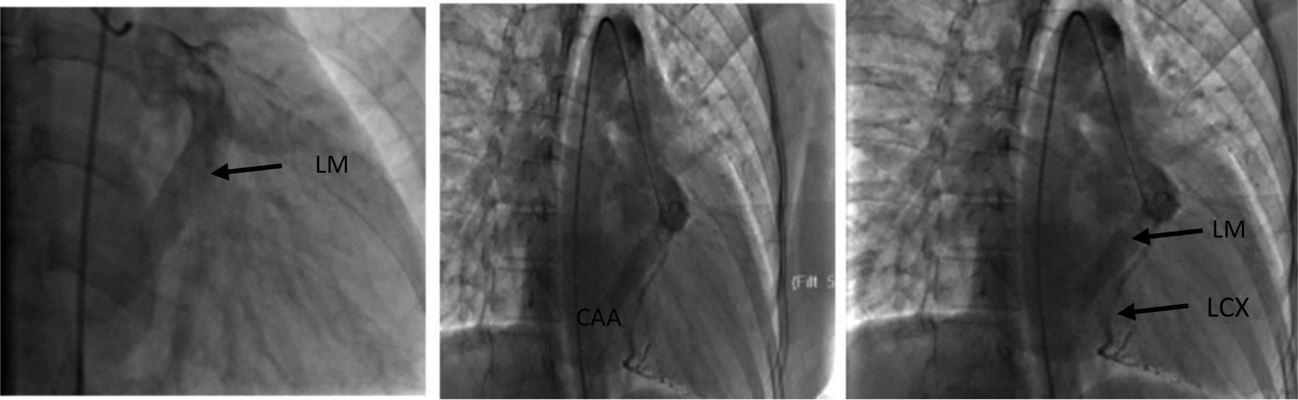 Radiologic evaluation of a giant aneurysmal left circumflex coronary ...