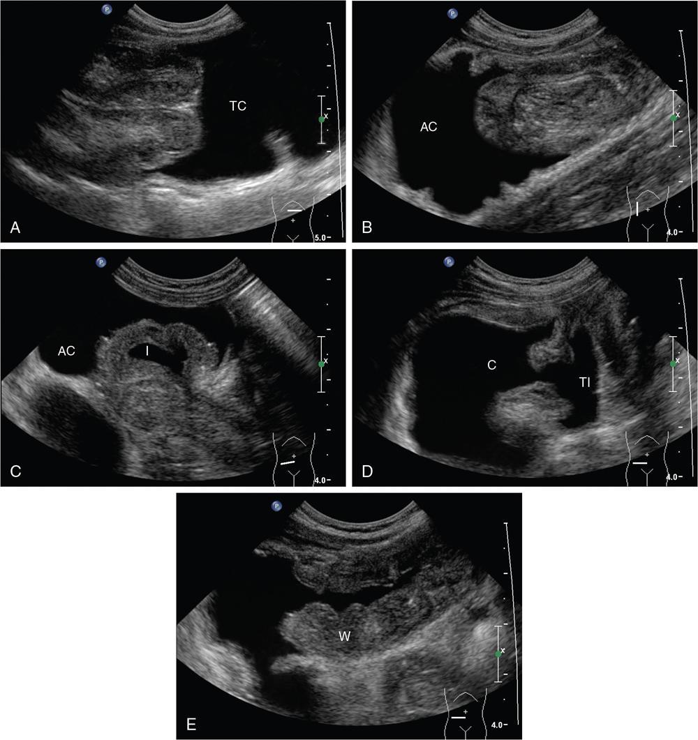 Intussusception | Radiology Key