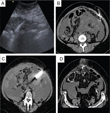 Ir Peritoneogram Peritoneum | Radiology Key