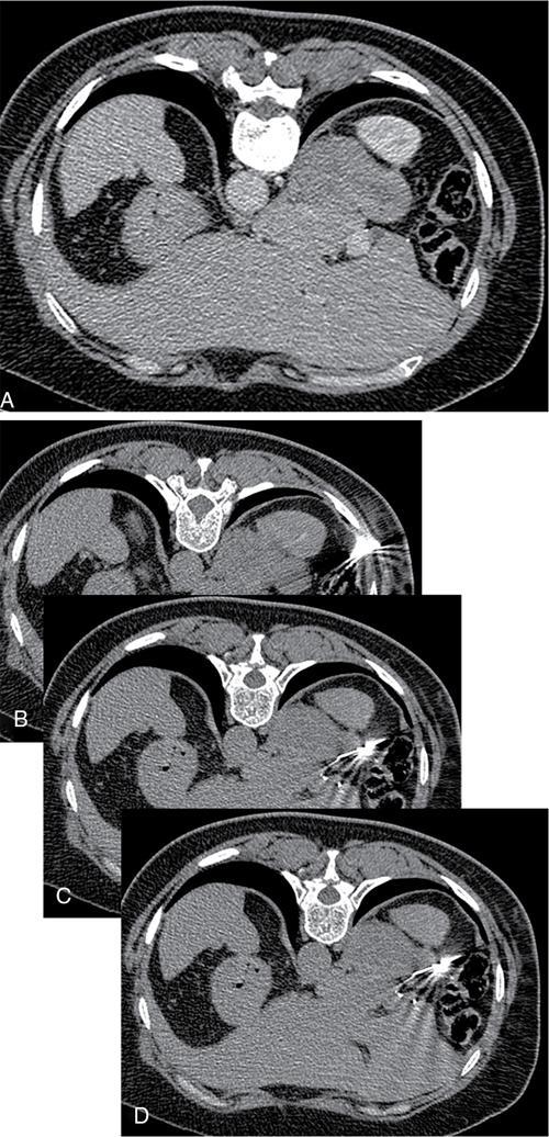 Adrenals | Radiology Key