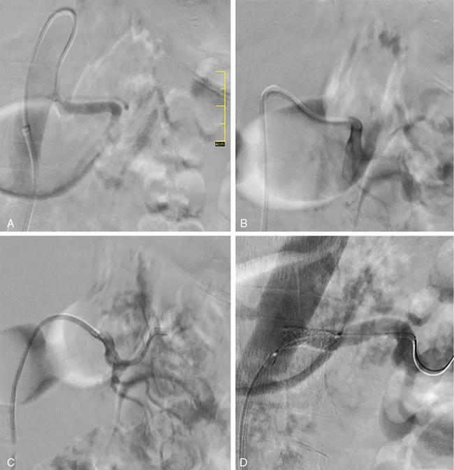 Endovascular management of renal artery stenosis | Radiology Key