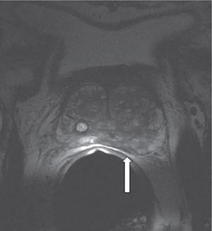 Signs in reproductive imaging | Radiology Key
