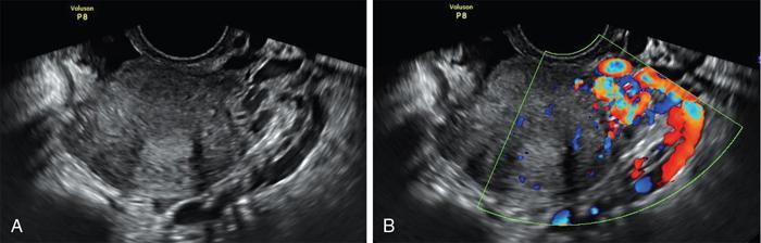 Fallopian tubes | Radiology Key